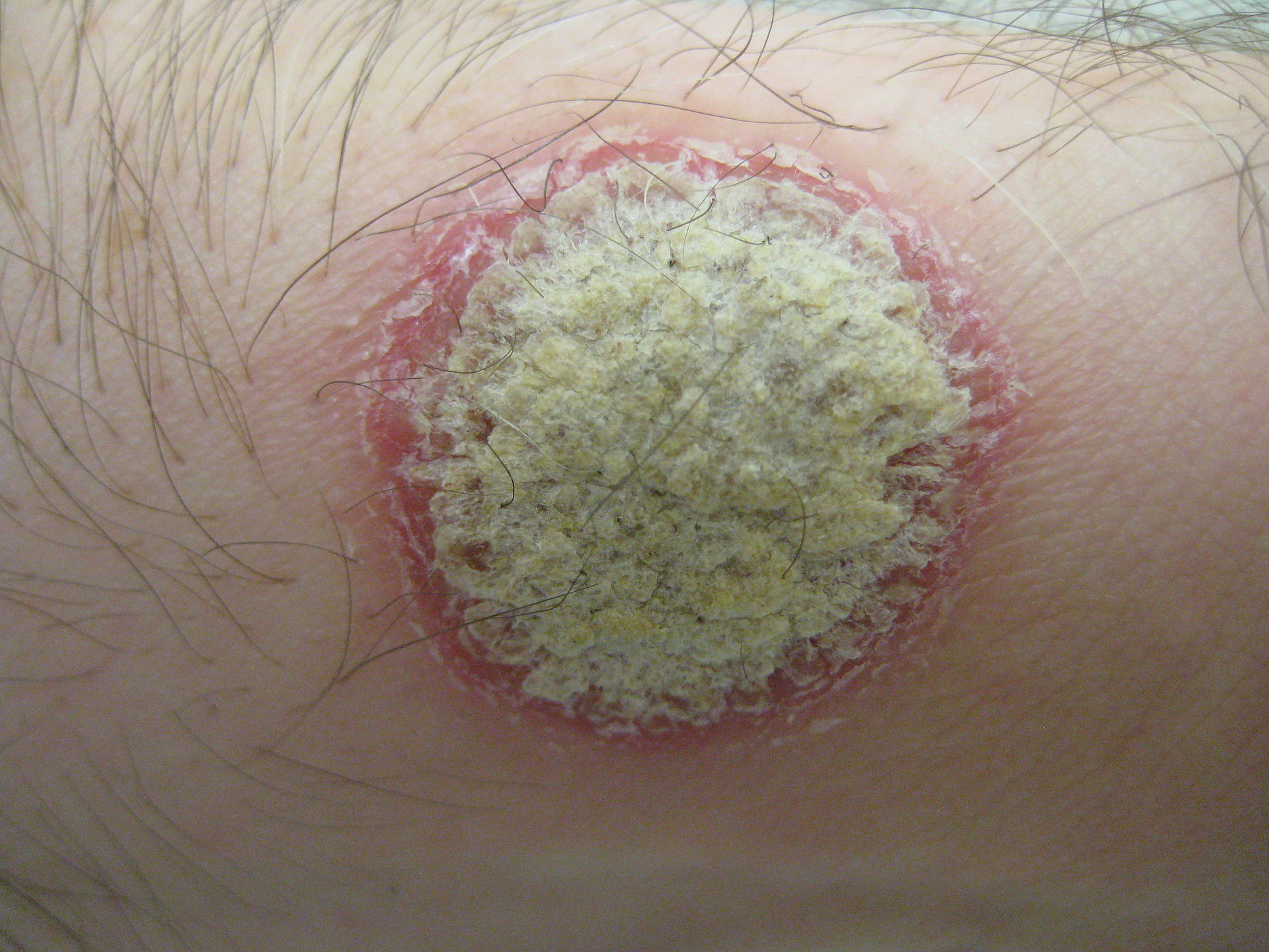 Psoriasis