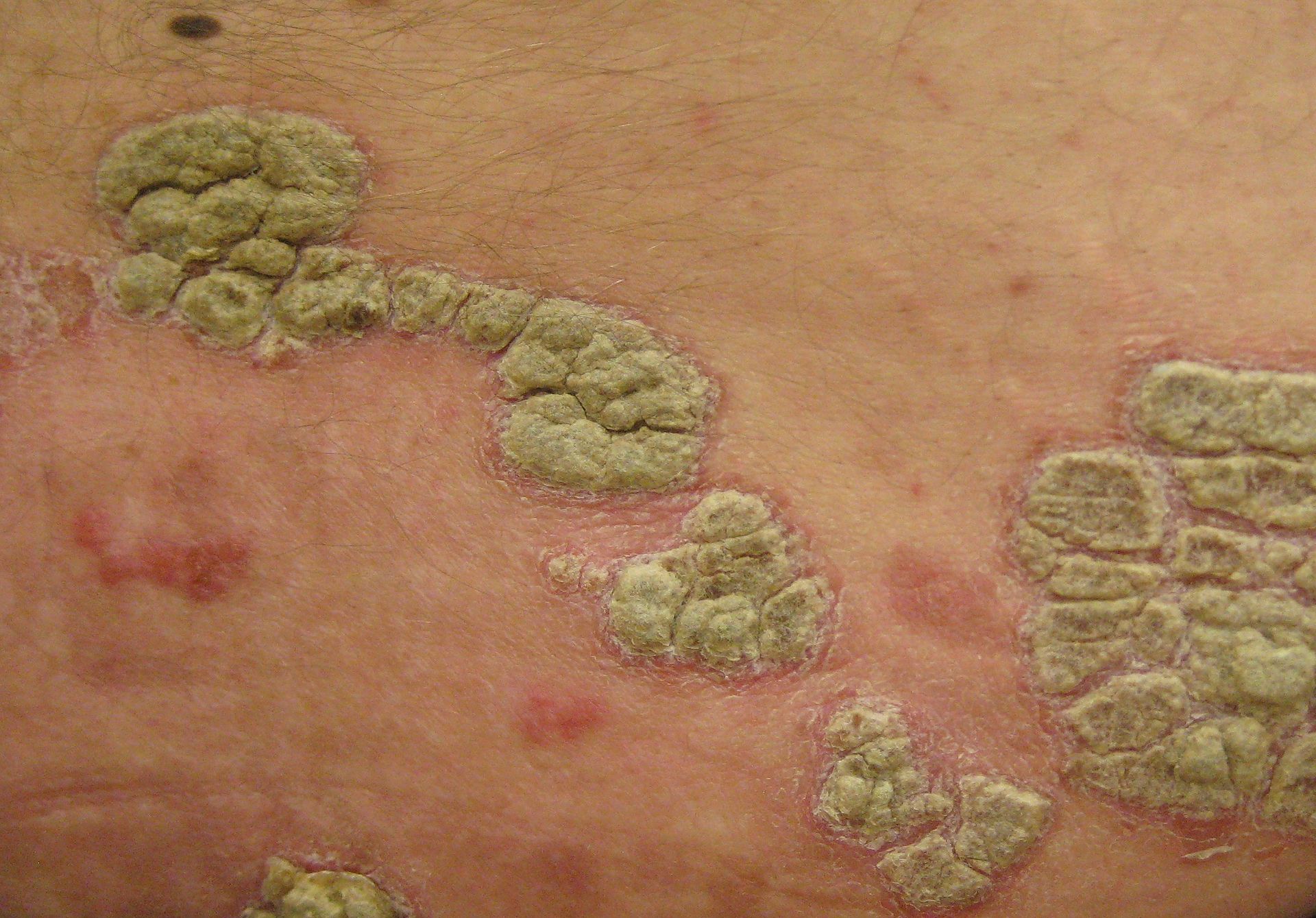 Psoriasis