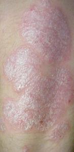 Psoriasis