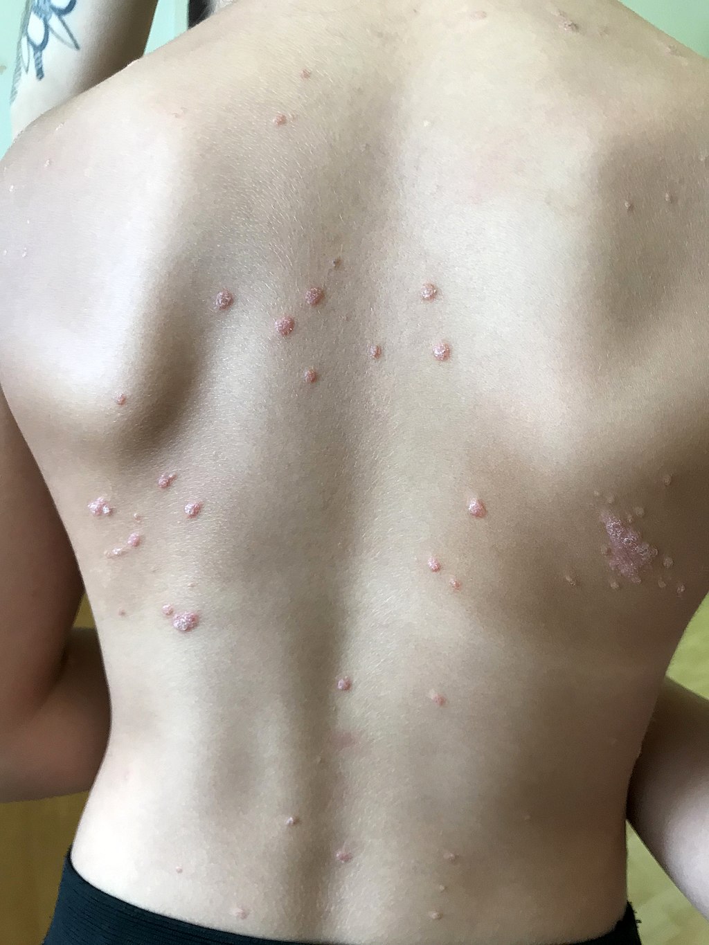 Psoriasis