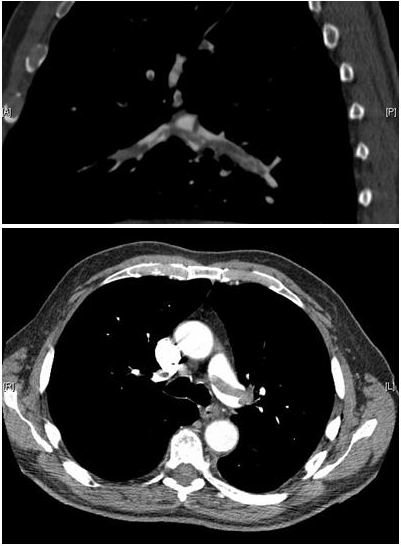 Pulmonary Embolism