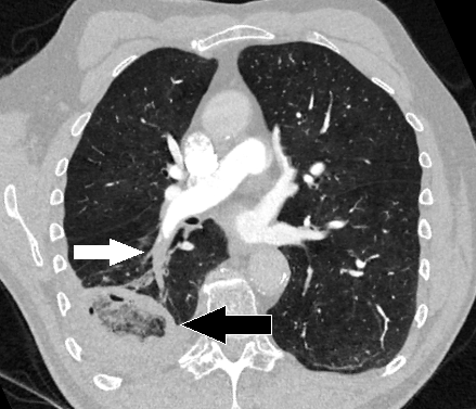 Pulmonary Embolism