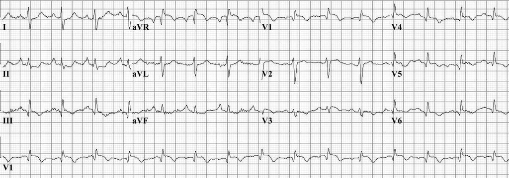 Pulmonary Embolism