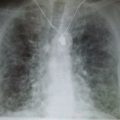 Interstitial Pneumonia