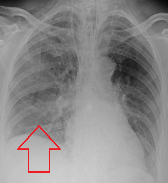 Aspiration Pneumonia