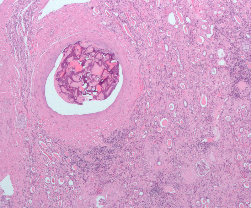 Renal Cell Carcinoma