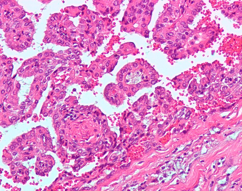 Renal Cell Carcinoma