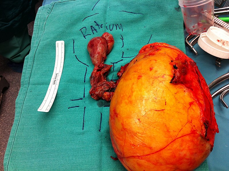 Renal Cell Carcinoma