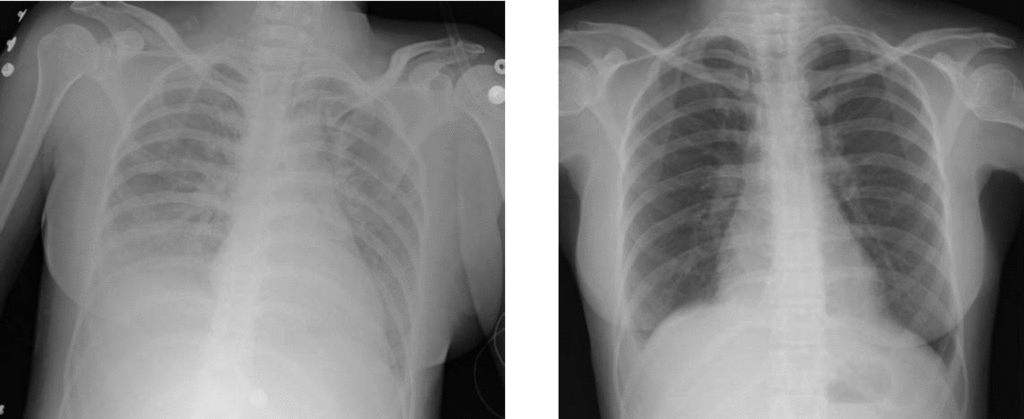 Respiratory Distress Syndrome Pathology