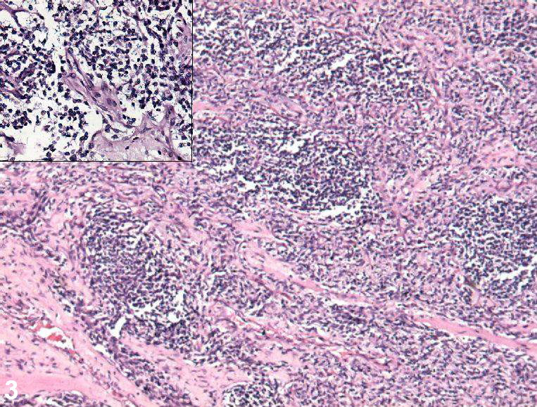 Rhabdomyosarcoma