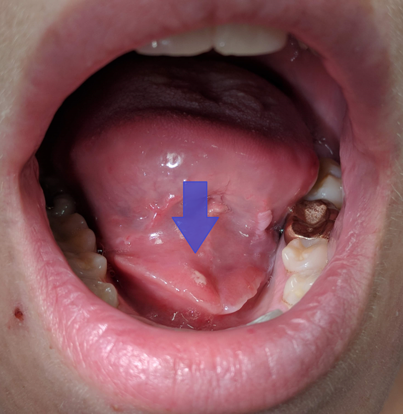 Salivary Gland Pathology