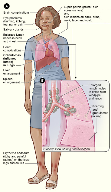 Sarcoidosis