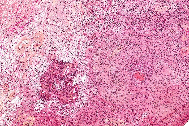 Schwannoma