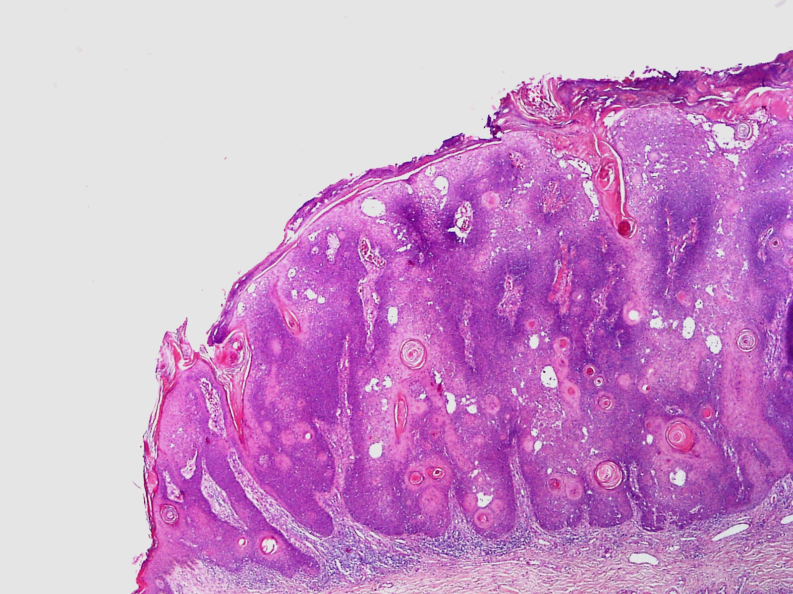 Seborrheic Keratosis
