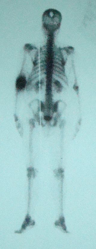 Seronegative Spondyloarthropathies