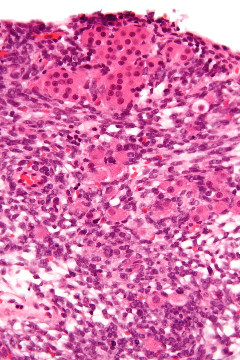 Sertoli-Leydig Cell Tumor