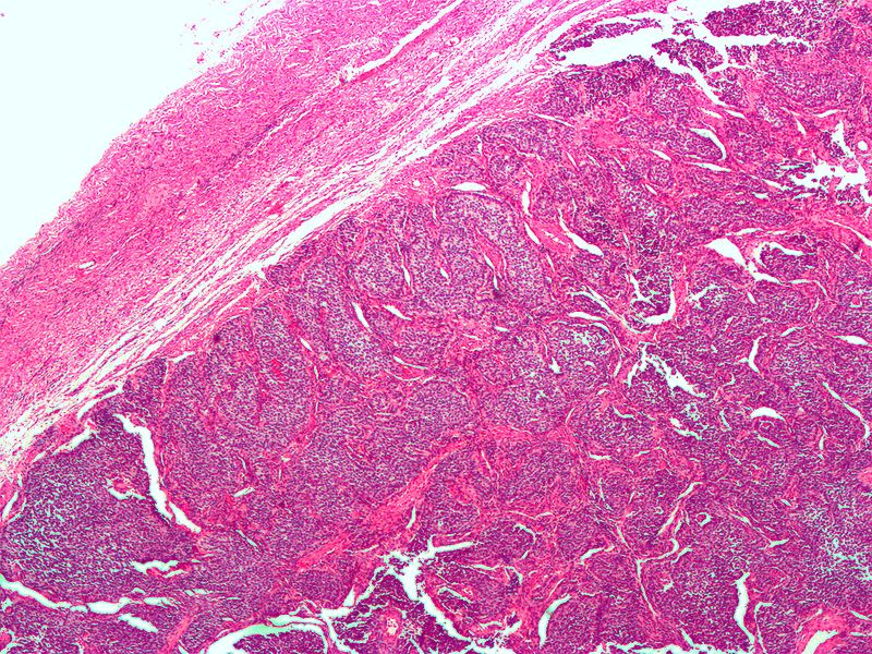 Sex Cord Stromal Tumors