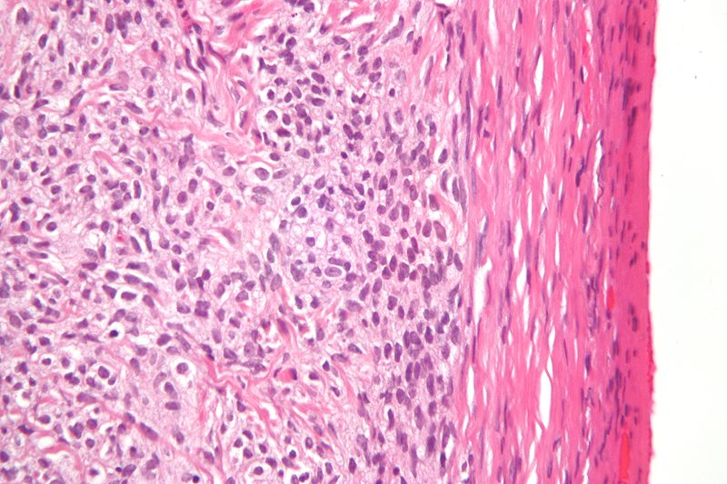 Sex Cord Stromal Tumors