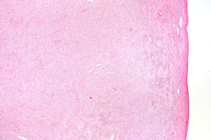 Sex Cord Stromal Tumors