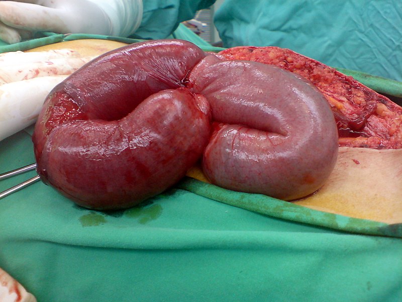Small Bowel Infarction