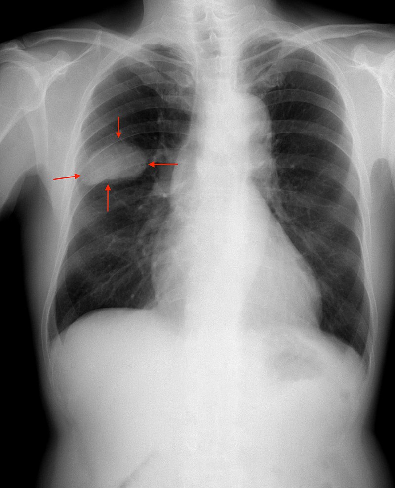 Small Cell Lung Carcinoma