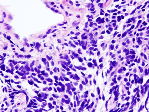 Small Cell Lung Carcinoma