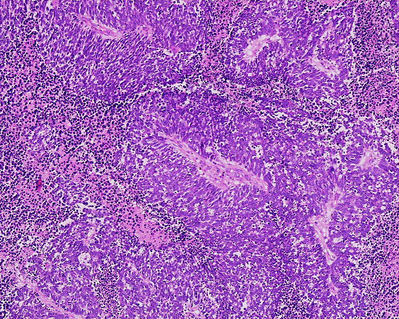 Small Cell Lung Carcinoma