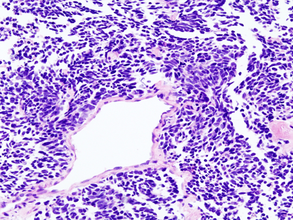 Small Cell Lung Carcinoma