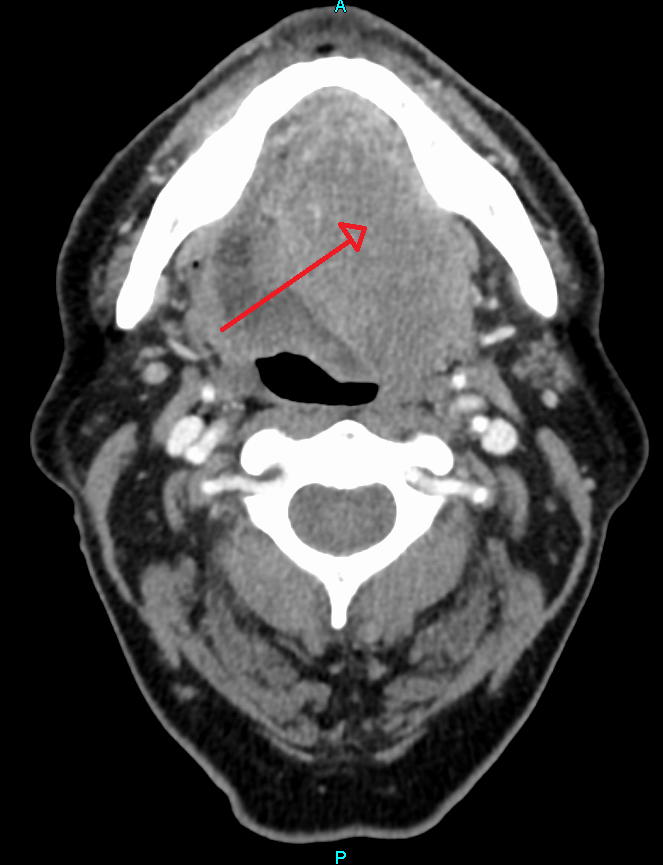 Squamous Cell Carcinoma