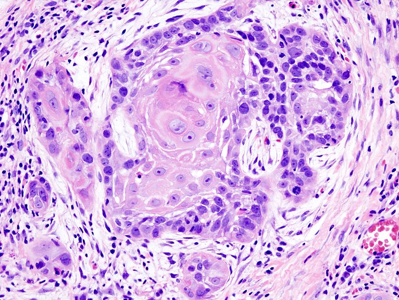 Squamous Cell Carcinoma