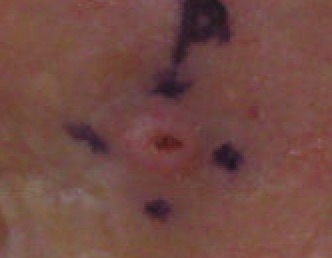 Squamous Cell Carcinoma