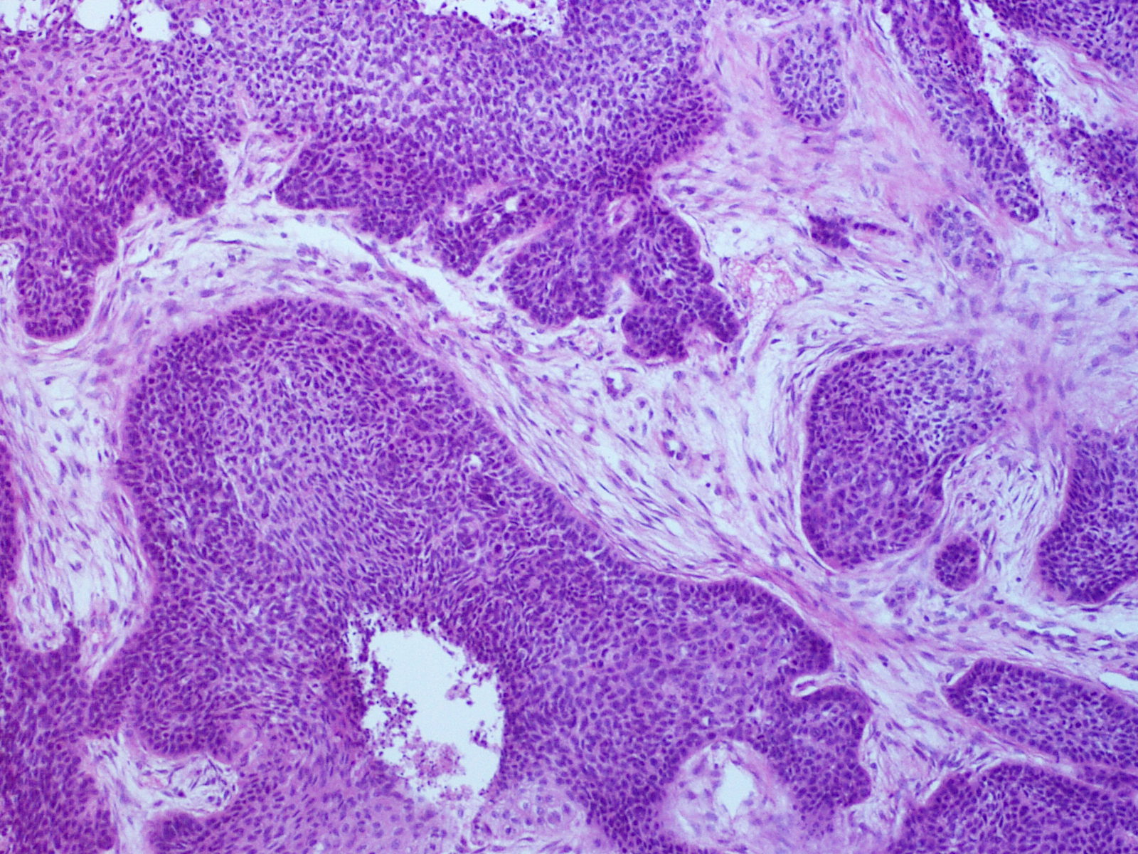 Squamous Cell Carcinoma