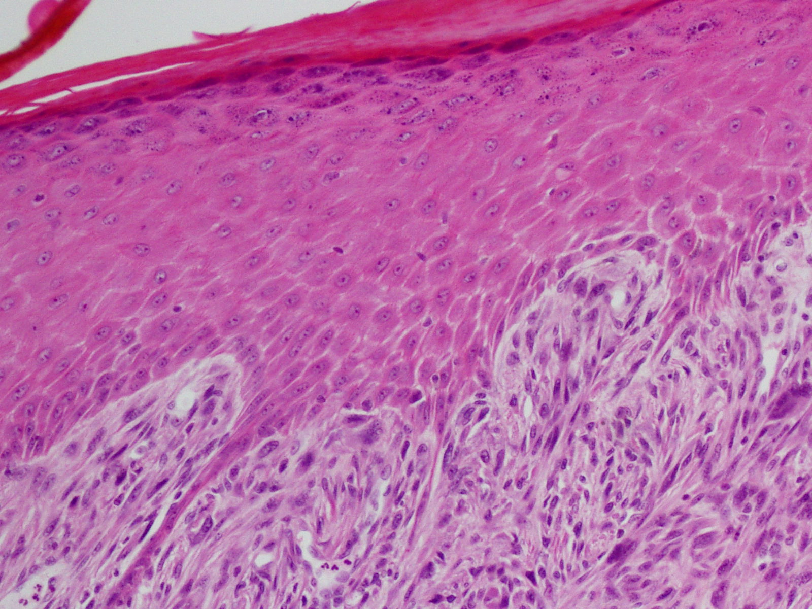 Spindle  Cell Squamous Cell Carcinoma. 