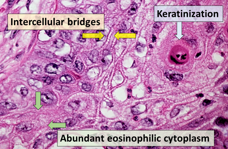 Squamous Cell Carcinoma of the Bladder