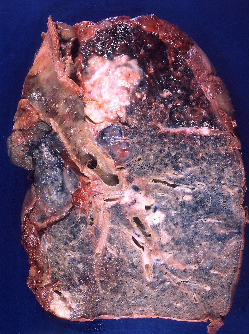 Squamous Cell Carcinoma of the Lung