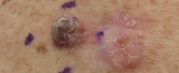 Squamous Cell Carcinoma 