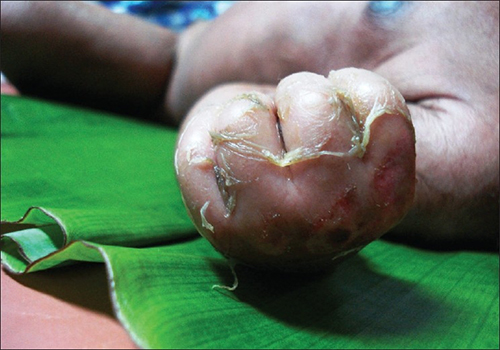 Staphylococcal Scalded Skin Syndrome