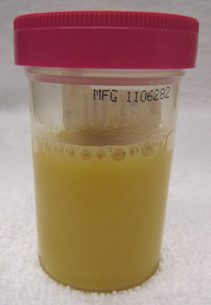 Sterile Pyuria