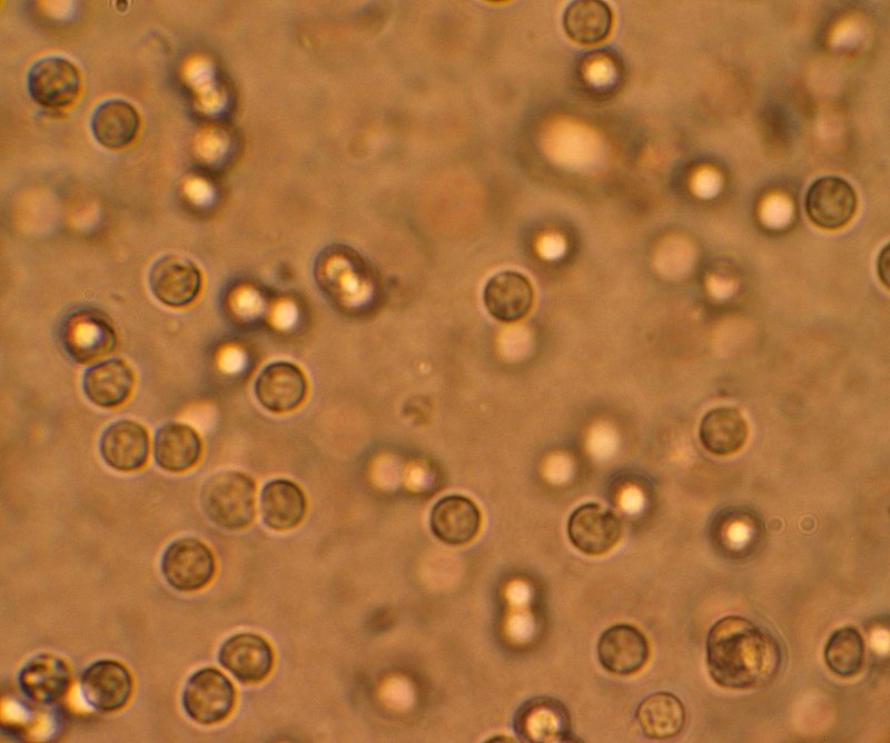 Sterile Pyuria