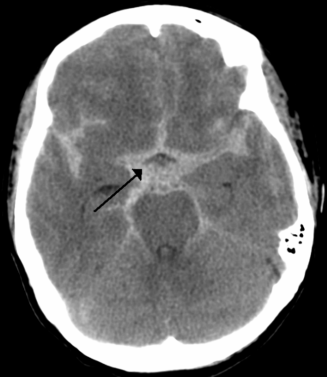 Subarachnoid Hemorrhage