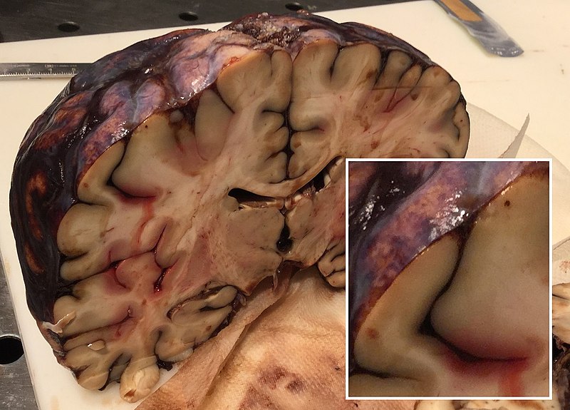Subarachnoid Hemorrhage