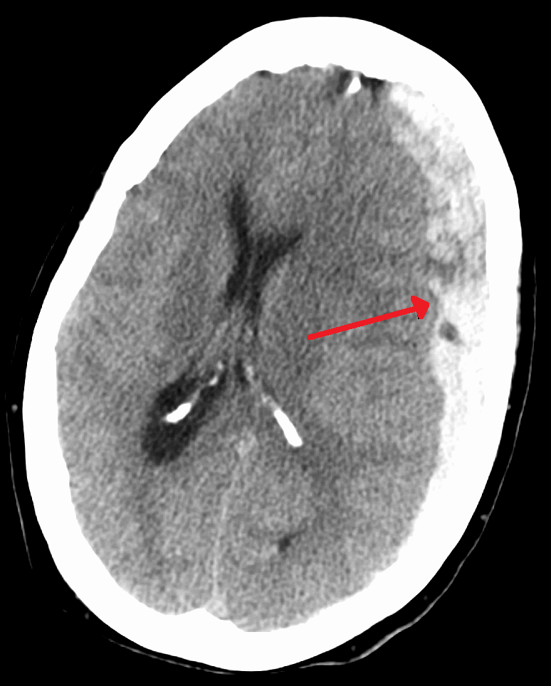 Subdural Hematoma