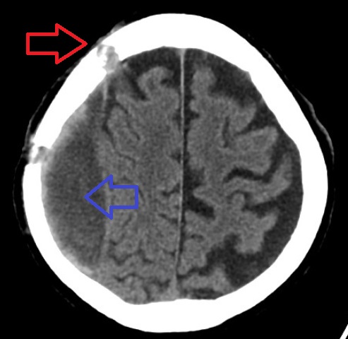 Subdural Hematoma
