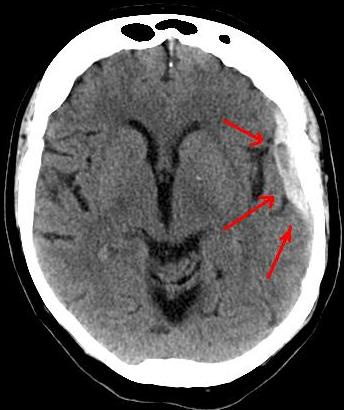 Subdural Hematoma