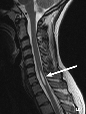 Syringomyelia