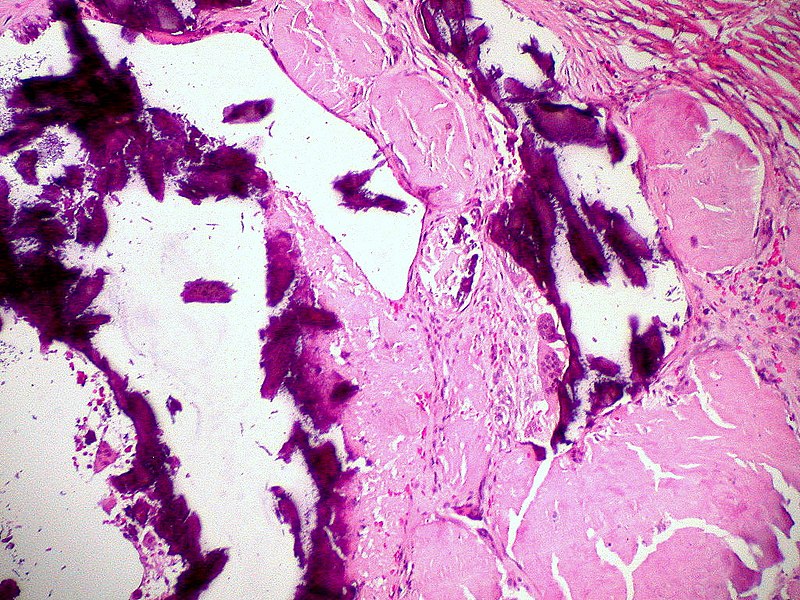 Systemic Amyloidosis