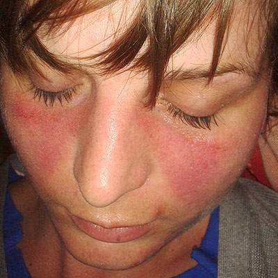 Systemic Lupus Erythematous (SLE)