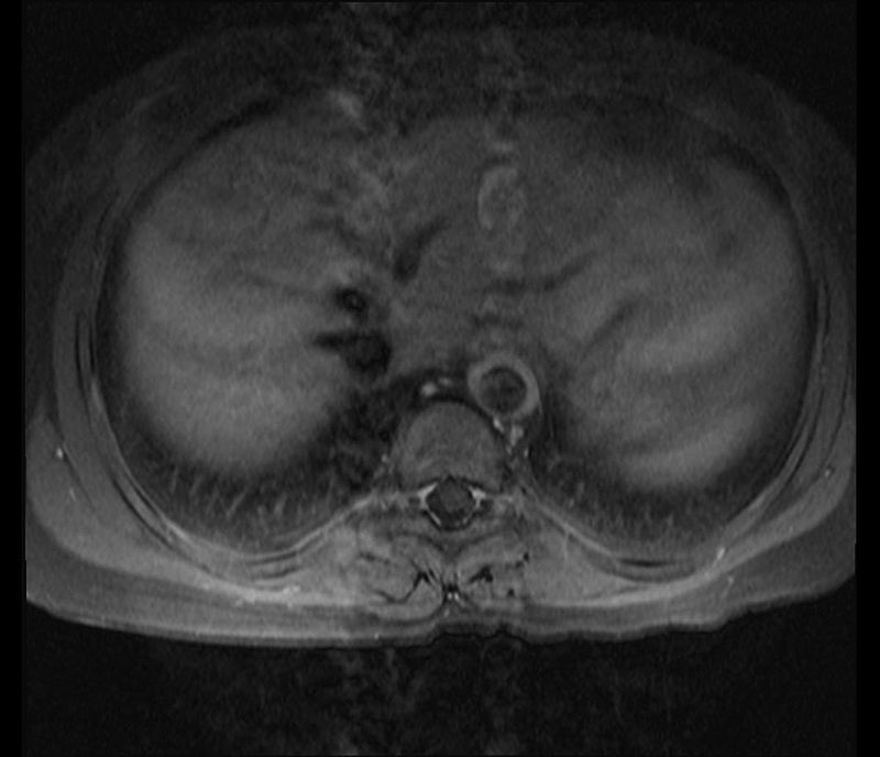 Takayasu Arteritis