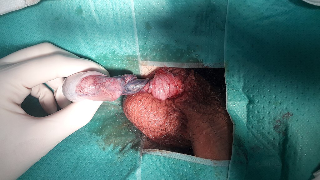Testicular Torsion