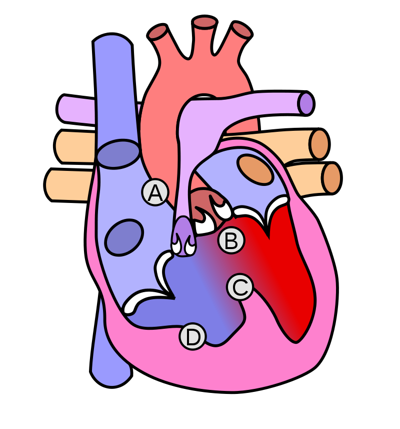 Tetralogy of Fallot